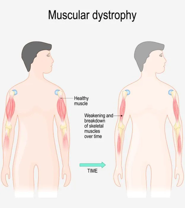 Muscular Dystrophy Treatment Cost