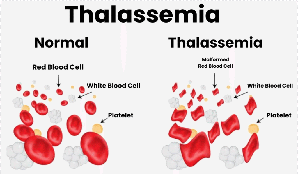 thalassemia treatment in india